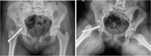 Tratamiento quirúrgico epifisiolisis. Tratamiento quirúrgico de caso de epifisiolisis inestable severa de cadera derecha (presentado en Figura 2). Se realizó una reducción cerrada de urgencia y fijación percutánea con tornillo canulado 7.0mm, además de descompresión percutánea de cápsula articular.