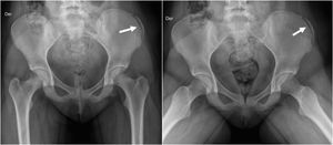 Fractura avlusiva ala ilíaca. Mujer de 13 años que consultó por dolor de cadera izquierda luego de realizar salto en atletismo. Se observa mínimo desplazamiento de fractura avulsiva de cresta ilíaca izquierda, lugar de inserción de músculo oblicuo externo.