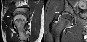 Pinzamiento femoroacetabular con rotura del labrum. Hombre de 13 años que consultó por dolor inguinal derecho de 2 meses de evolución, aumenta con deportes especialmente fútbol. RM muestra derrame articular derecho, signos de retroversión acetabular y desinserción del labrum anterosuperior (flecha).