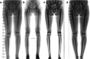 Estudio radiológico de niña de 12 años de edad con diferencia de longitud de extremidades inferiores. (a) Muestra diferencia de 2 centímetros. Se realiza fisiodesis con tornillos transfisiarios percutáneos (b). Control a los 9 meses demuestra corrección de la diferencia de longitud (c). Dado potencial de crecimiento remanente se procede a retiro de tornillos. Control radiológico un año tras retiro de tornillos confirma crecimiento simétrico, sin diferencia de longitud (d).