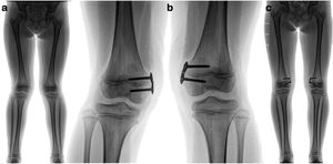 Estudio radiológico de niña de 8 años de edad con genu valgo idiopático. Estudio radiológico de niña de 8 años de edad con genu valgo idiopático (a). Se realiza hemifisiodesis en fémur distal con placa en banda de tensión (b). Eje corregido a los 15 meses postoperado (c).