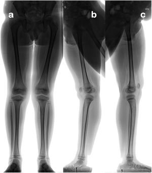 Estudio radiológico estandarizado para evaluación de ejes de extremidades inferiores. Telerradiografía anteroposterior en carga, con pelvis nivelada y rótulas al frente (a), telerradiografías laterales en carga monopodal derecha (b) e izquierda (c), con extensión máxima.