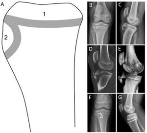 Centros de osificación y lesión fisiaria de tibia proximal. (A) Esquema de los centros de osificación de la tibia proximal (visión lateral): Centro de osificación primario (1) y secundario (2). (B y C) Radiografía anteroposterior (A) y lateral (B) de avulsión de la tuberosidad anterior de la tibia. (D y E) Imágenes de tomografía computada de rodilla, confirmando la fractura avulsiva Tipo Ogden III, con un rasgo coronal que compromete el centro de osificación secundario y primario de la tibia proximal. (F y E) Radiografía anteroposterior y lateral tras la reducción abierta y fijación interna de la fractura avulsiva con dos tornillos canulados 4.0mm paralelos a la fisis. (Ref. 5).