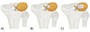 Clasificación de Watanabe para menisco lateral discoideo. (A) Tipo I, Discoideo completo. (B) Tipo II, Cobertura incompleta de la superficie tibial (no más del 80%) estable a la palpación, con inserciones coronales. (C) Tipo III (Variante Wrisberg), normal o forma levemente discoide con inestabilidad debido a ausencia de fijación coronal posterior, solo mantiene el ligamento de Wrisberg. (Ref. 24).