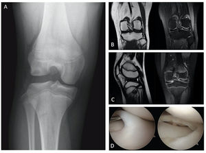 Signos imagenológicos y visión artroscópica de menisco discoideo. (A) Proyección radiográfica anteroposterior (AP) de rodilla sin carga con menisco discoideo lateral. Se observa un aplanamiento del cóndilo femoral lateral, un aumento del espacio articular y una deformidad del platillo tibial lateral en forma de “copa”. (B, C) Resonancia magnética (RM) de rodilla, cortes coronal y sagital T1 y FAT SAT confirmando un menisco lateral discoideo completo con un aumento de señal intrasustancia sugiriendo una degeneración mixoidea del menisco. (D) Imagen artroscópica de el mismo paciente, a la izquierda el menisco discoideo completo, y luego a la derecha la imagen final tras realizar un tallado meniscal artroscópico.