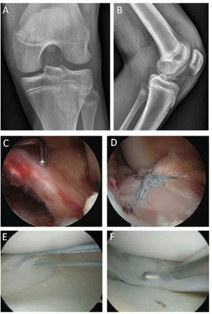 Caso clínico avulsión de LCA y lesión meniscal concomitante. (A) Proyección AP y (B) Lateral de una fractura avulsiva de la espina tibial. (C) Visión artroscópica del mismo paciente que muestra la avulsión ósea de la inserción del ligamento cruzado anterior, que además compromete la raíz anterior del menisco lateral que se está incorporada en el fragmento óseo avulsionado. (B) reducción artroscópica y fijación con suturas de alta resistencia de la fractura avulsiva. (C) Rotura meniscal concomitante del cuerno posterior del menisco externo. (D) Reparación de lesión longitudinal del cuerno posterior del menisco lateral con dos suturas verticales con técnica todo-dentro.