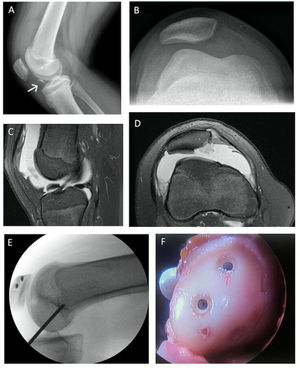 Caso clínico luxación patelar. Radiografía lateral (A) y axial de rótula (B) de una paciente con primer episodio de luxación patelar, evidenciando una displasia troclear, tilt y subluxación de la rótula. Además, se observa un fragmento osteocondral en el surco intercondíleo. Imágenes de RM del mismo paciente, cortes: sagital (C) y axial (D) PD Fat Sat, confirman una luxación patelar reciente asociado a una fractura osteocondral de la patela (C, D). (E) Estabilización quirúrgica de la patela mediante una reconstrucción del ligamento patelofemoral medial, utilizando dos anclas en la patela y un túnel en el fémur distal en posición anatómica. (F) Reinserción del fragmento osteocondral en la patela utilizando tornillos bioabsorbibles.
