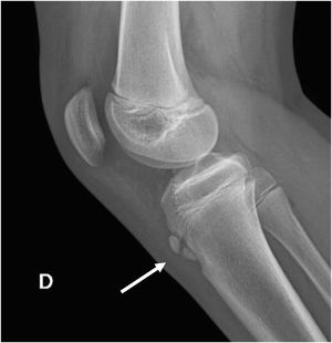 Enfermedad de Osgood Schlatter. Radiografía lateral de rodilla con fragmentación de apófisis de la tuberosidad anterior de la tibia (flecha) en paciente de sexo masculino de 14 años portador de enfermedad de Osgood Schlatter.