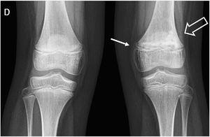 Lesión fisiaria de fémur distal. Radiografía de rodillas comparativa que muestra lesión fisiaria de fémur distal izquierdo en paciente de sexo femenino de 11 años. Se observa ensanchamiento fisiario (flecha) y cambios metafisiarios (flecha gruesa).