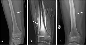 Fractura por estrés de fémur. Paciente de sexo masculino 9 años con dolor progresivo de muslo derecho luego de práctica intensiva de fútbol. A. Radiografía de fémur derecho con reacción perióstica (flecha). B. Imagen de resonancia magnética de fémur derecho con edema óseo y rasgo de fractura por estrés. C. Radiografía de fémur derecho 3 meses de evolución, con formación de callo óseo y fractura consolidada.