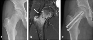 Fractura por estrés de cuello femoral. Paciente de sexo masculino 14 años, jugador de fútbol, con coxalgia derecha progresiva. A. Radiografía AP de cadera derecha sin evidencia de fractura. B. Imagen de resonancia magnética de cadera derecha (realizada el mismo día) que muestra fractura incompleta de cuello femoral en zona de alto riesgo. C. Radiografía AP de cadera derecha 2 meses de evolución, luego de osteosíntesis con tornillos.