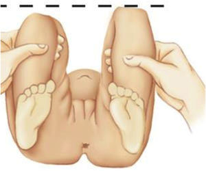 Signo clínico de Galeazzi. Este examen permite establecer sospecha de displasia del desarrollo de cadera (DDC) unilateral ante una diferencia de longitud de ambos fémures. Imagen disponible en: https://boneandspine.com/developmental-dysplasia-of-hip/.