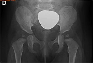 Radiografía pelvis antero-posterior para el tamizaje de DDC. Paciente pediátrico con protector de plomo para cubrir los órganos genitales.