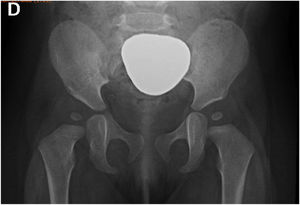 Radiografía pelvis antero-posterior para el tamizaje de DDC. Paciente pediátrico con protector de plomo para cubrir los órganos genitales.