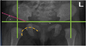 Radiografía de pelvis antero-posterior. En color verde se resaltan las líneas de Hilgenreiner (H) y Perkins (P). Con la línea de Hilgenreiner y el techo cotiloideo (en rosado) se obtiene el ángulo acetabular (A), y en amarillo el arco de Shenton (S). (Ref.12).