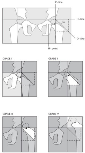 Clasificación radiológica según el International Hip Dysplasia Institute (IHDI, por sus siglas en inglés) para displasia del desarrollo de cadera. Esta clasificación no requiere de la osificación del núcleo de la cabeza femoral. Utilizando las ya conocidas líneas de Hilgenreiner y Perkins (líneas H y P), se traza un ángulo de 45° en la intersección de ambas líneas (hacia caudal y lateral), lo que determina la línea D. Además de estas 3 líneas se utiliza un punto de referencia denominado Punto H (punto medio de la metáfisis proximal del fémur). El punto H sirve de eje; su ubicación respecto de las demás líneas determina 4 grados. (Ref.12).