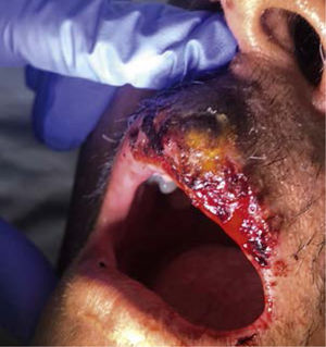 Herpes labial impetiginizado en paciente inmunocomprometido El impétigo no buloso (INB) secundario representa el 70% de los casos de impétigo y es causado principalmente por S. aureus o Streptococcus pyogenes. Se produce sobre otra dermatosis subyacente que alteran la barrera cutánea.