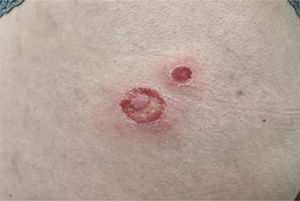 Impétigo ampollar o buloso (IB) en región glútea.