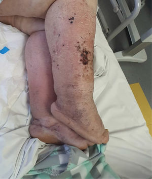 Linfedema de extremidades inferiores complicado con celulitis estafilocócica en paciente postrado con hospitalización prolongada .