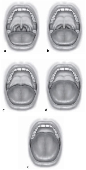 Escala modificada de Mallampati (también conocida como escala de Friedman de posición lingual) para evaluación de la relación entre paladar y lengua a. Posición I: Se visualiza la úvula y amígdalas/pilares. b. Posición IIa: Se visualiza la mayor parte de la úvula pero no las amígdalas/pilares. c. Posición IIb: Se visualiza todo el paladar blando hasta la base uvular. d. Posición III: Muestra parte del paladar blando con su extremo distal ausente. e. Posición IV: Sólo se visualiza el paladar duro. Fuente: Friedman M, Salapatas AM, Bonzelaar LB. Updated Friedman Staging System for Obstructive Sleep Apnea. Adv Otorhinolaryngol. 2017;80:41-48. doi: 10.1159/000470859. (Ref.14).