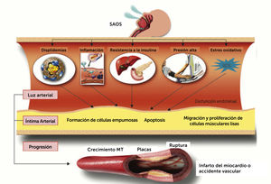 Principales mecanismos que relacionan el SAOS a las enfermedades cardiovasculares. Fuente modificada de Drager LF, Polotsky VY, Lorenzi-Filho G, 201110.