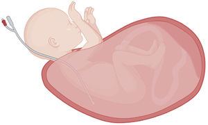 Exposición fetal necesaria para un EXIT. La exposición del feto durante un EXIT debe ser sólo la indispensable para lograr la maniobrabilidad del procedimiento. El presente diagrama representa la exteriorización de un feto desde la cavidad uterina, con exposición de la cabeza, el cuello y ambos brazos, por ejemplo, para el control de la vía aérea superior. El parto parcial del feto, junto con la colocación de una sonda intrauterina de amnioinfusión paralela al tórax, contribuyen a mantener el volumen uterino y a reducir la pérdida de calor y el riesgo de compresión del cordón. Creado con software BioRender.