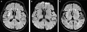Imagen de resonancia magnética. A: Secuencia FLAIR en fase aguda mostrando hiperintensidad en ganglio basal derecho. B: Secuencia DWI (difusión) en fase aguda mostrando isointensidad en ganglio basal derecho descartando la presencia de infarto. C: Secuencia FLAIR, dos meses después se observa disminución de la hiperintensidad en el ganglio basal derecho.