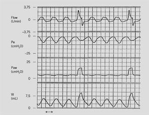 Ventilación mandatoria intermitente sincronizada (SIMV). Registro simultáneo de curva de flujo de vía aérea, presión esofágica (deflección negativa ilustra al esfuerzo respiratorio del paciente dado por la contracción diafragmática), presión de vía aérea y volumen corriente generado en un RN. Como se observa, las respiraciones mecánicas están sincronizadas y coinciden con el inicio del esfuerzo.