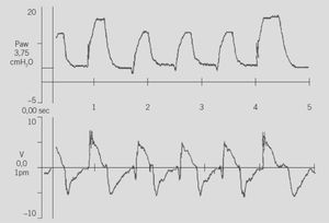 SIMV+Presión de Soporte. Registro simultaneo de curva de presión de vía aérea y flujo. Como se observa, las respiraciones espontáneas están apoyadas con una presión adicional pero con un nivel menor cerca del 70% que los ciclos mecánicos completos.
