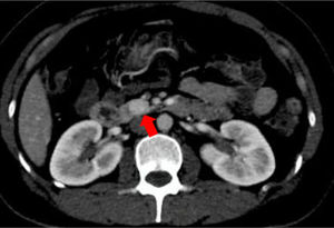 Tomografía axial computarizada en fase arterial. Muestra nódulo solido hipercaptador y homogéneo, bordes definidos de 15×13mm en proceso uncinado.
