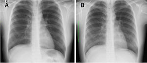 Radiografía de tórax de hace tres meses (A); actual (B).