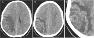 TAC simple de encéfalo; edema vasogénico extenso (A), nódulo con cápsula precoz (B y C).