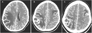 Tomografía contrastada de encéfalo; (A), (B) y fase retardada (C).