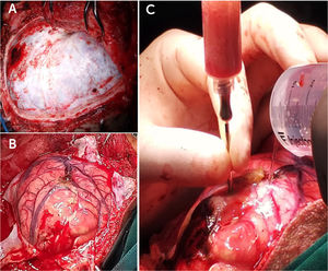 Intervención quirúrgica; craneotomía descompresiva (A), y drenaje de contenido purulento de abscesos encapsulados (B y C).