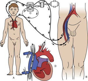 Esquema de la circulación cruzada controlada. Esquema de la circulación cruzada controlada, en la que un “donante”, habitualmente el padre o la madre de un niño, servía como oxigenador para efectuar la cirugía a corazón abierto. Figura modificada de Lillehei CW: Controlled cross circulation for direct-vision intracardiac surgery: correction of ventricular septal defects, atrioventricularis communis, and tetralogy of Fallot, Post Grad Med [Minneapolis] 17:288-396, 1955.