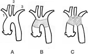 Options for Aortic Arch Surgery. A: normal aortic arch. B: Supra-aortic arch branches reimplanted as an Island. C: Supra-aortic arch branches reimplanted separately. 1: Innominate trunk 2: Left common carotid 3: Left subclavian artery.