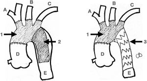 Elephant Trunk. The classic Elephant Trunk procedure (left picture) is the combination of the classic open aortic arch replacement with a Dacron graft (1) and a free-floating extension of the arch prosthesis into the descending aortic true lumen (2). The Frozen Elephant Trunk (right picture) version is with the forward endovascular deployment of a self-expandable covered stent. (3) in the descending thoracic aortic true lumen. A: Innominate trunk B: Common carotid artery C: Left subclavian artery D: Ascending aorta E: Descending thoracic aorta.