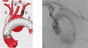 Hybrid Approach. Left picture shows an almost total endovascular aortic arch replacement. A: TEVAR. B: extra anatomic right carotid to left carotid to left subclavian bypass. C: chimney stent to the innominate trunk. D: left subclavian artery amplatz plug to avoid type II endoleak. Right picture shows the completion angiogram with patency of the chimney stent and flow through the extra-anatomical bypass.