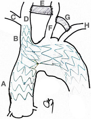 Branched stent and debranching. A: Ascending Aorta. B: Innominate trunk. C: Right subclavian. D: Right common carotid. E: R-Carotid to L-Carotid bypass (8mm graft). F: Left common carotid. G: L-Carotid to L-subclavian Bypass (8mm graft). H: Left subclavian.