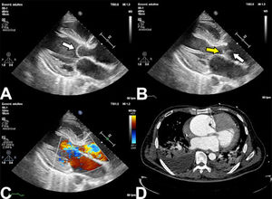 Hallazgos en ecocardiografía en síndrome aórtico agudo. A: Se observa el desgarro intimal que cruza la válvula aórtica en diástole (flecha blanca). B: En sístole se observan dos estructuras (flecha blanca y amarilla) con movimiento independiente. C: Con doppler color se observa insuficiencia de la válvula causada por la distorsión de la coaptación valvular. D: En TAC se confirma la presencia de DA aguda tipo A.