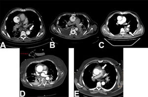 Hallazgos en TAC de pacientes con síndromes aórticos agudo. A: Se observa el desgarro intimal en la aorta ascendente (asterisco) que se extiende hasta la descendente (flecha). B: Se observa el desgarro intimal limitado a la aorta ascendente (asterisco). C: Se observa la disección con falsa luz parcialmente trombosada en la aorta descendente (flecha). D: Hema- toma intramural en la aorta ascendente con la característica forma creciente (asterisco). Caso cortesía Dr David Preston, Radiopaedia.org, rID: 27746. E: Úlcera aórtica penetrante ubicada en el borde lateral izquierdo de la aorta ascendente (flecha). Caso cortesía Dr. Jens Christian Fischer, Radiopaedia. org, rID: 12810.