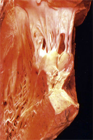 Aparato valvular mitral. Preparación anatómica del aparato valvular mitral. Es posible apreciar la continuidad estructural entre el esqueleto cardíaco y la pared libre del ventrículo izquierdo a través del anillo mitral, los velos mitrales, las cuerdas tendíneas y los músculos papilares, lo que a su vez determina la geometría y arquitectura de la cavidad ventricular izquierda, y, por lo tanto, la función contráctil del ventrículo izquierdo.