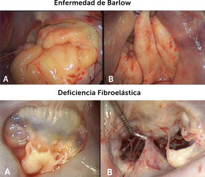 Dos principales formas de valvulopatía mitral degenerativa. Fotografías intraoperatorias de las dos principales formas de valvulopatía mitral degenerativa. Se observa la redundancia de tejido de la Enfermedad de Barlow, con compromiso de toda la válvula y lo limitado del proceso anatómico de la deficiencia fibroelástica, en este caso circunscrito a los segmentos medio y posterior del velo mitral posterior10.