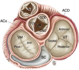 Anatomía de la válvula tricúspide y relación con estructuras cardíacas. VT: válvula tricúspide, VM: válvula mitral, VA: válvula aórtica, VP: válvula pulmonar, SC: seno coronario, CCI: cúspide coronariana izquierda, CCD: cúspide coronariana derecha, CNC: cúspide no coronariana, ACx: arteria circunfleja, ACD: arteria coronaria derecha. Salazar G, Gelves J.10.