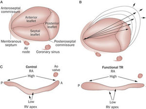 Anatomía de la válvula tricuspídea. Anatomía de la válvula tricuspídea (A) y del anillo tricuspídeo normal (C, izquierda) con su punto alto situado en dirección anteroposterior y su punto más bajo en situación mediolateral. En pacientes con insuficiencia tricuspídea funcional, el anillo se torna más plano (C, derecha) dilatándose su diámetro anteroposterior (B). A: anterior P: posterior AD: aurícula derecha IT: insuficiencia tricuspídea. Tornos Mas P, et al.