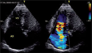 Imagen ecocardiográfica doppler color previo a cirugía de una insuficiencia tricuspídea severa.
