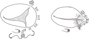 Anuloplastía de Kay. Consiste en una sutura doble entre las comisuras posteroseptal y anteroposterior con el objetivo de plegar el velo y anillo posteriores, consiguiendo una válvula bicúspide. Roselló-Díez E.57.