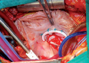 Anuloplastía tricuspídea mediante anillos protésicos. Resultado final en el que se aprecia coaptación total de los velos. Flores E, et al.43.
