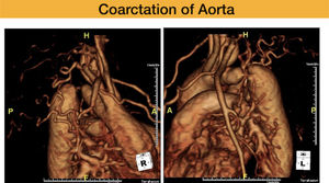 Coarctation in an adult showing multiple collaterals.