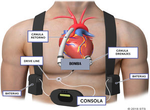 Esquema asistencia ventricular izquierda. Tomado de:.https://ctsurgerypatients.org/adult-heart-disease/leo-ventricular-assist- device-lvad.